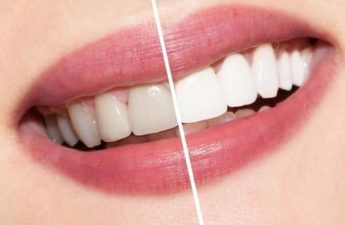 teeth whitening strips reviews